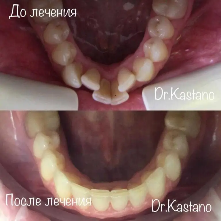 Клинический пример коррекции скученности на элайнерах
