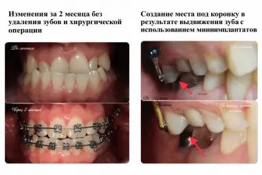 До и после исправления прикуса