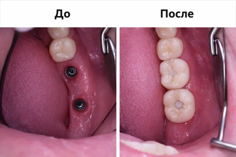 Клинический пример имплантации в боковом отделе зубного ряда